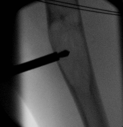 UBC Humerus Drilling